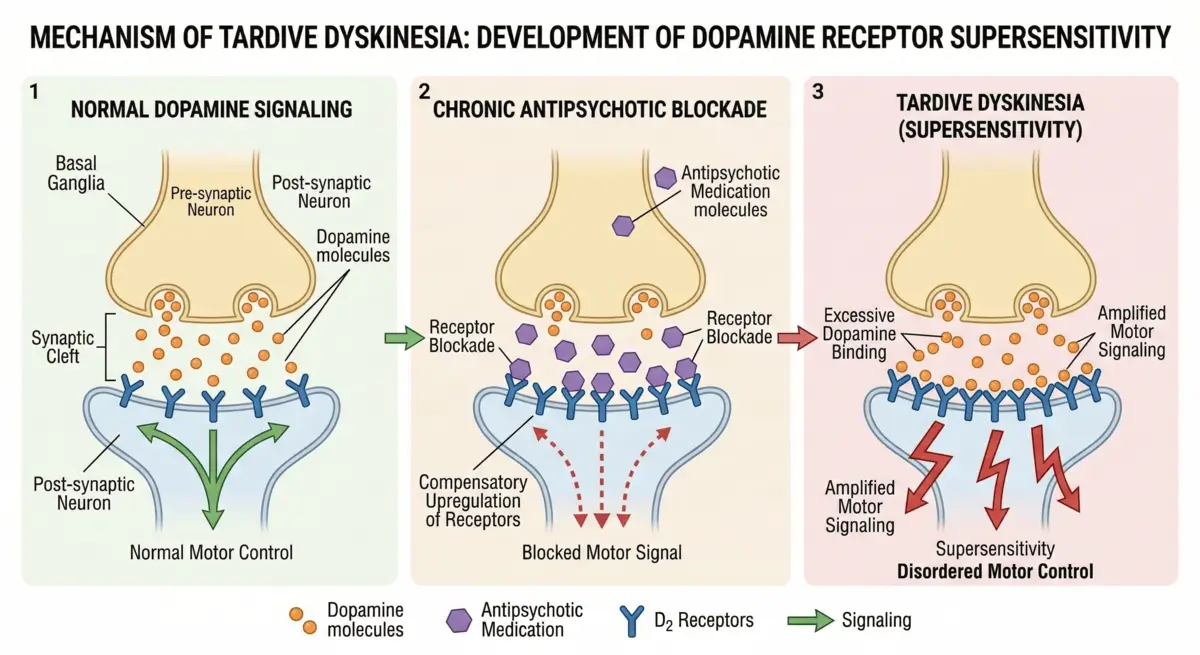 Medical diagram illustrating the development of dopamine receptor supersensitivity in Tardive Dyskinesia due to chronic antipsychotic use